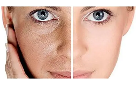 مراقبت میکرونیدلینگ