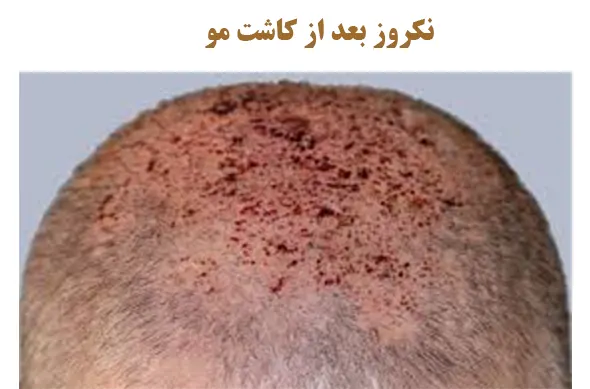 زخم بعد از کاشت