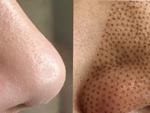 پلاسماتراپی بینی