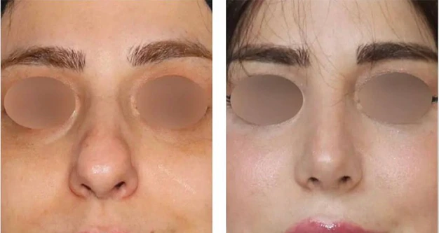 پلاسماجت بینی