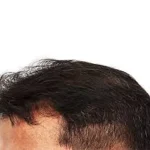 کاشت مو پرتراکم