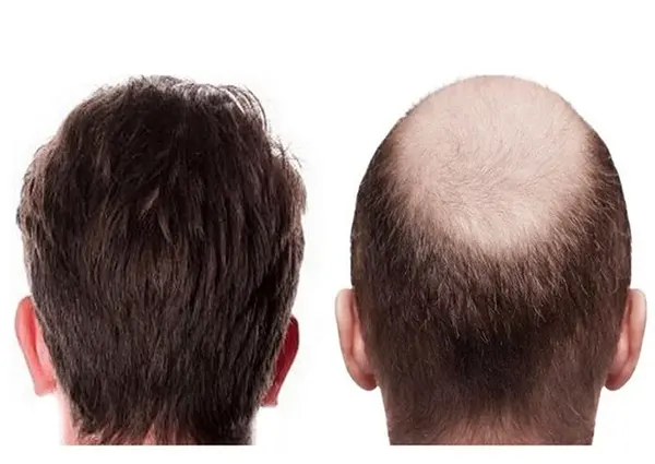 کاشت مو اقایان در تهران