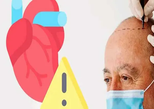 کاشت مو در بیماران قلبی