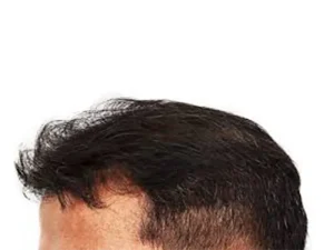 کاشت مو پرتراکم